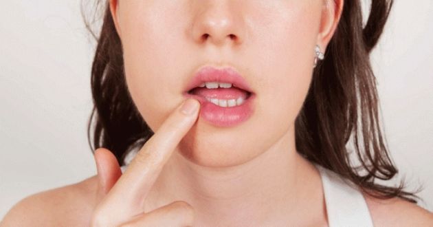 9+ nguyên nhân khiến bạn bị nhiệt miệng thường xuyên cần biết để phòng ngừa - META.vn