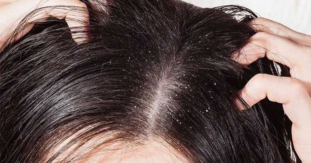 Triệu Chứng Nấm Da đầu Phan Biệt Nấm Da đầu Va Gau